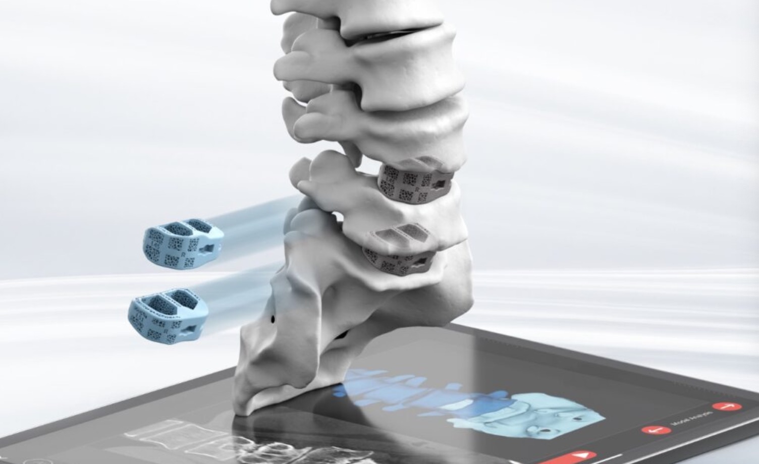 Carlsmed拟纳斯达克上市，筹资7.25亿元加速3D打印脊柱植入物技术升级