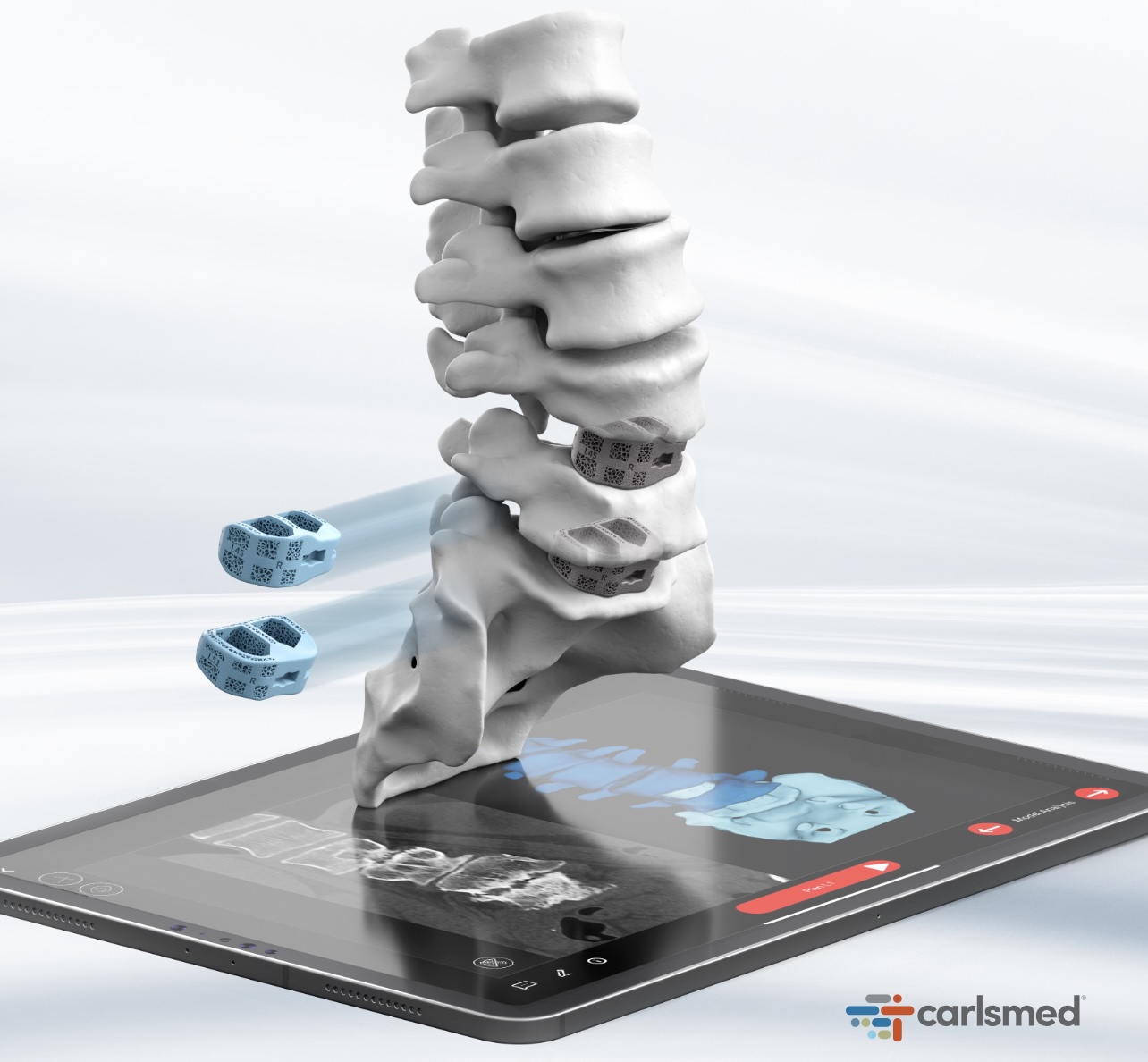 融资1亿美元，Carlsmed成功在纳斯达克IPO上市，助推3D打印脊柱植入物发展