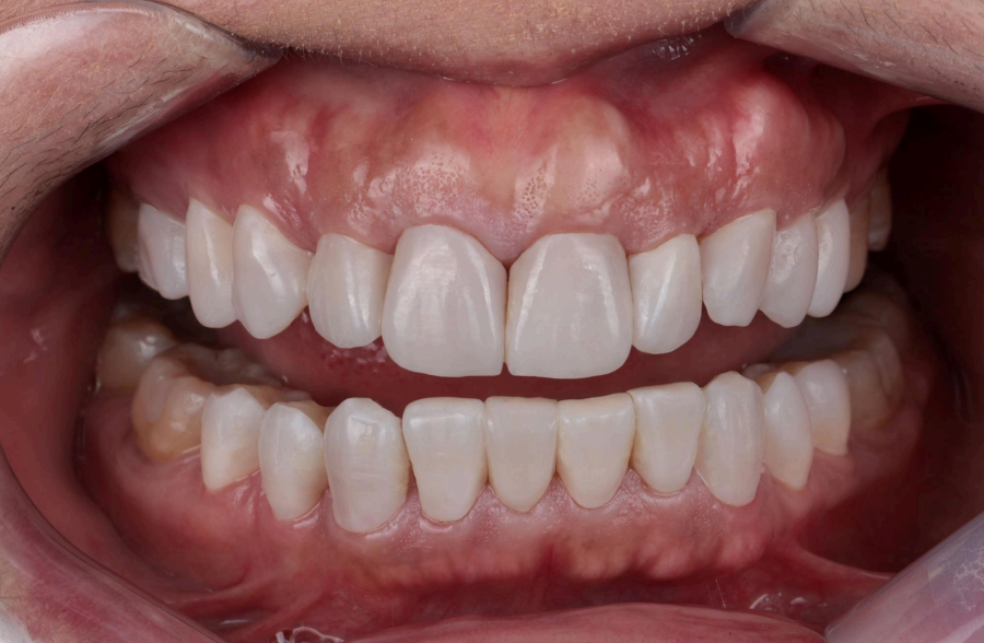 波士顿微制造(BMF)推出革命性3D打印牙贴面 完美解决四环素牙难题