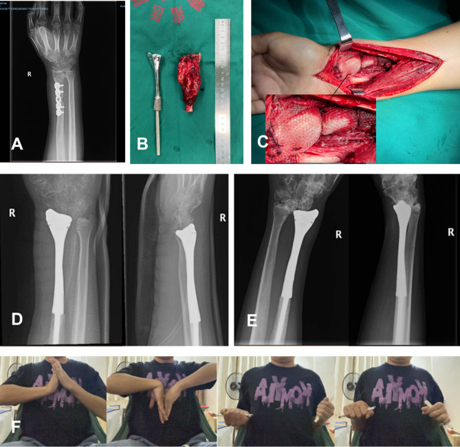 一位25岁女性的病例研究。（A）术前X光片；（B）术中植入包裹有网片的三维金属假体；（C）术后第三天的前后位和侧位X光片；（D）术后32个月的X光片