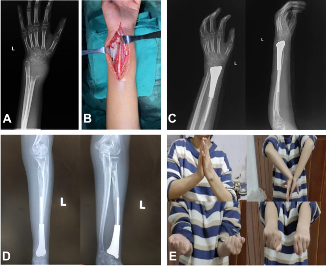 22岁男性病例研究。（A）术前X光片；（B）肿瘤切除及假体植入术中图像；（C）术中放置包裹在网状移植物中的3D打印金属假体；（D）术后X光片（3天，前后位和侧位视图）；（E）术后X光片。