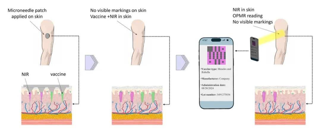 3D打印混合微针贴片：实现疫苗接种与隐形医疗记录一体化