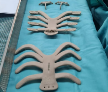 克拉利特-贝林森医院使用3D打印PEKK植入物为患者重建胸壁